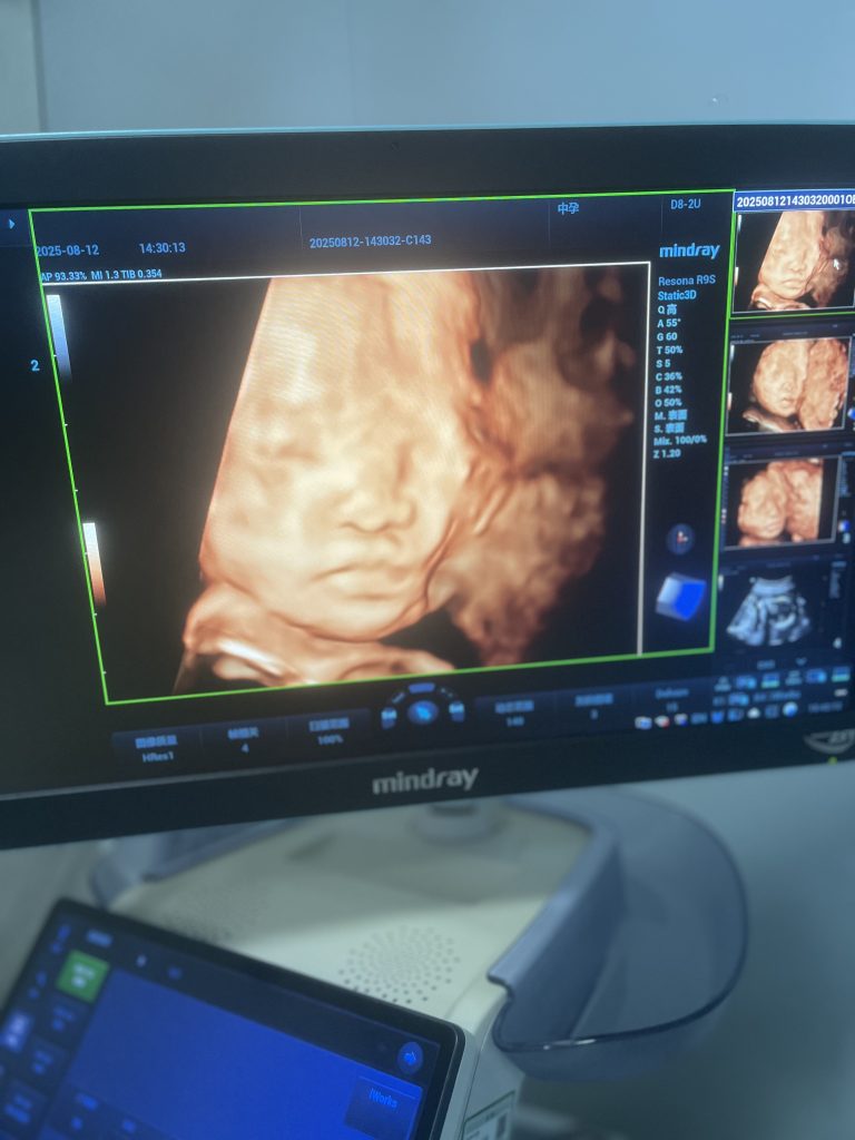 图片[1]-小宝的第一张照片出来啦（四维彩超）-清风小筑-雷国胜的个人网站